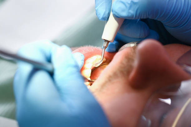 Best Emergency Tooth Extraction in South San Jose Hills, CA